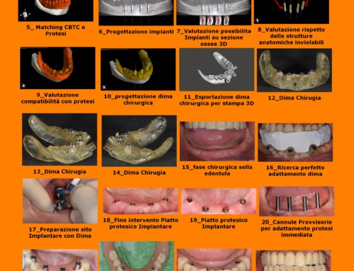 La digitalizzazione negli studi dentistici, scopriamo cos’è! – Caso Clinico  Implantologia Computer Guidata a carico Immediato