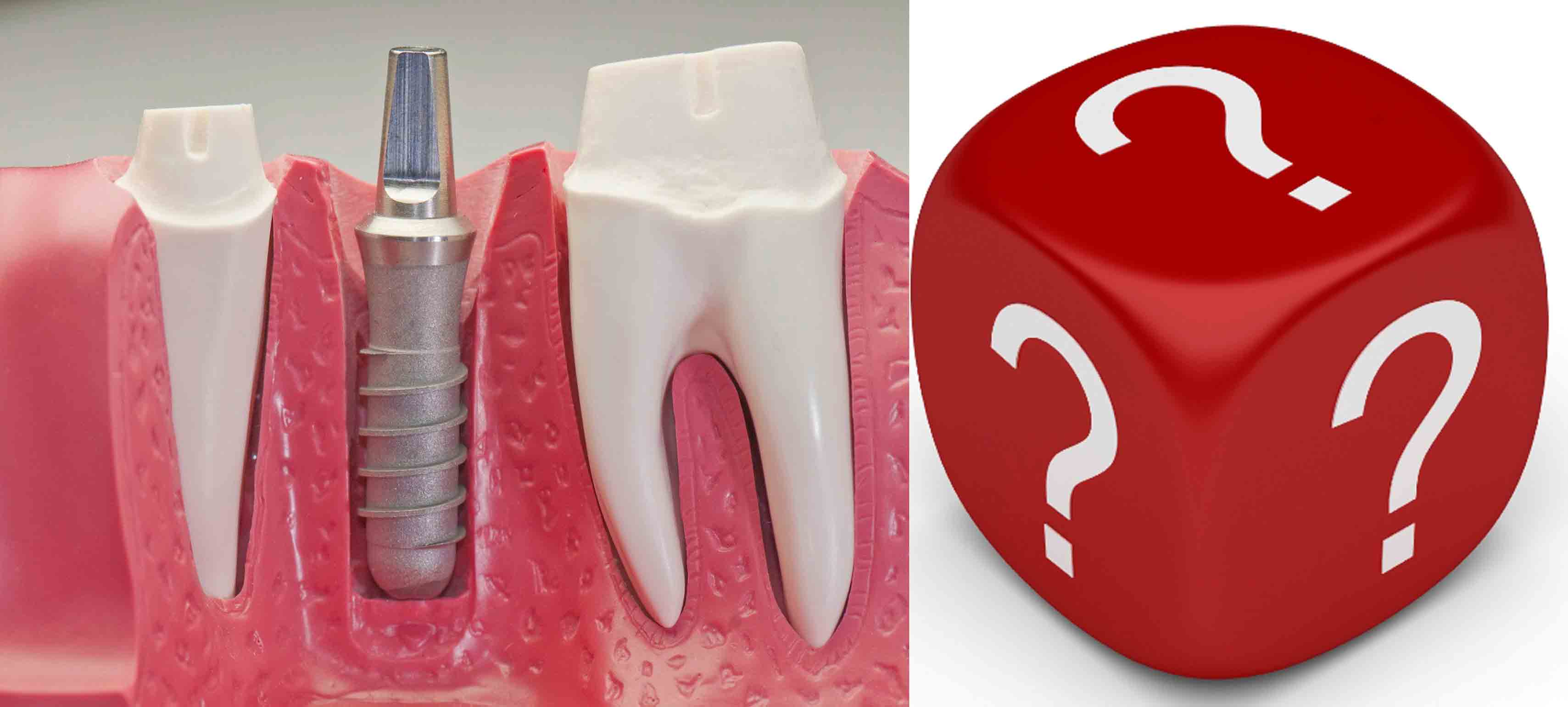 curare il dente naturale