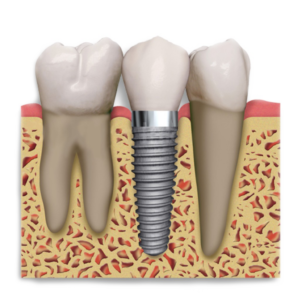 impianto-dentale