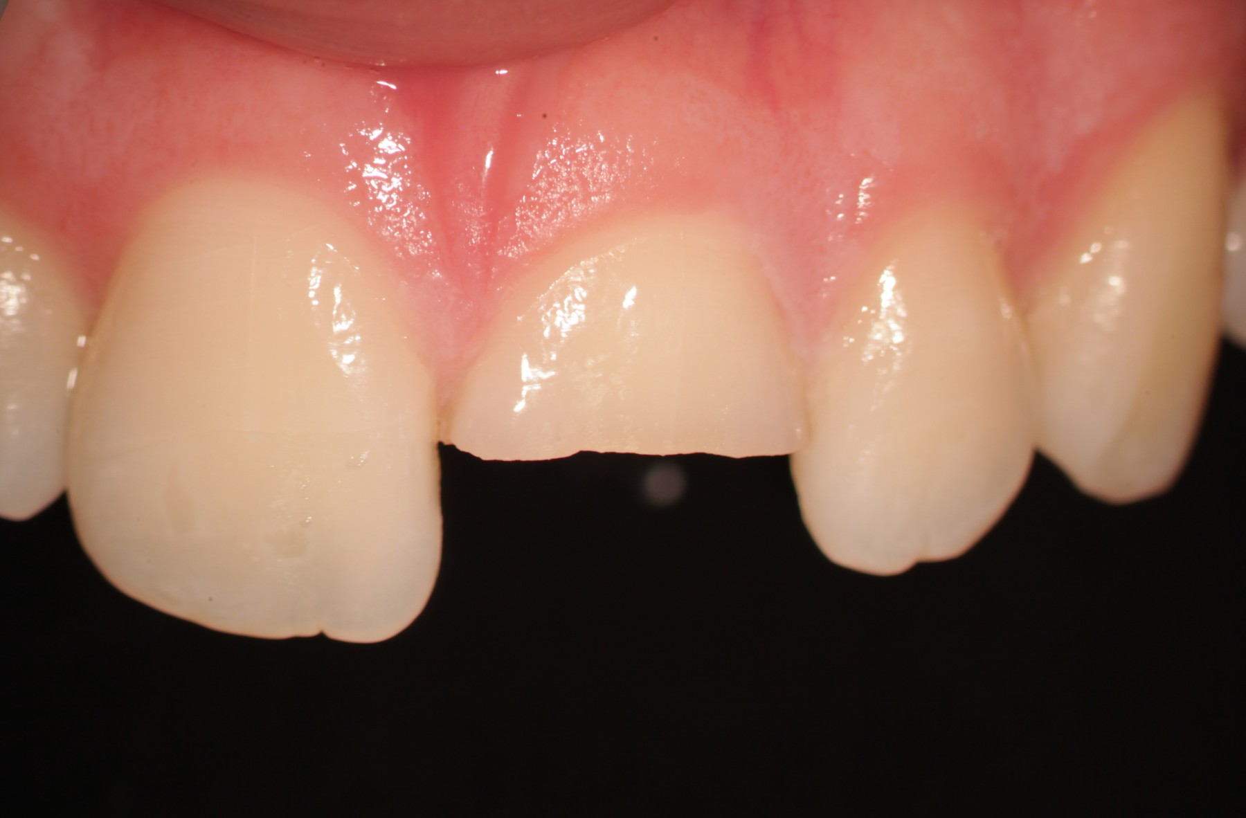 Traumi dentali come evitare e comportarsi